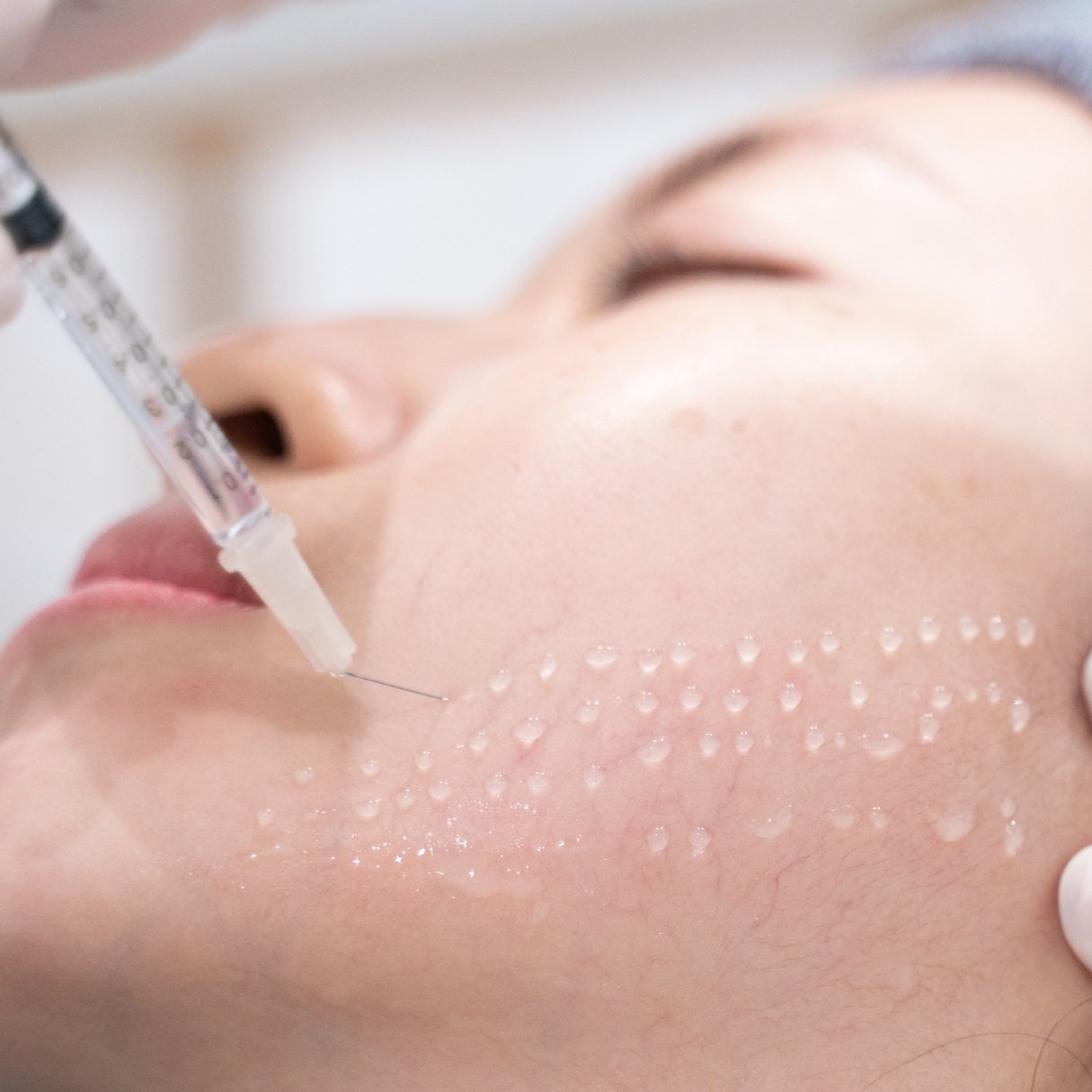 İğneli Mezoterapi Fiyatı | WWW İstanbul