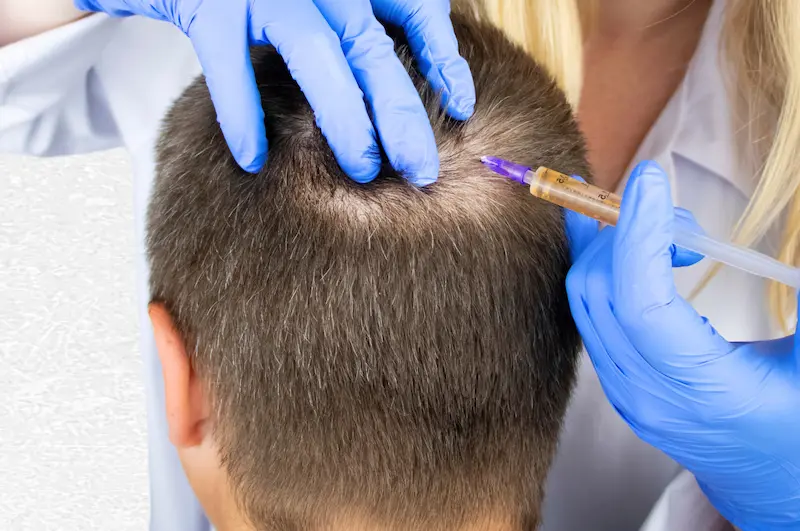 Mezoterapi Saç Tedavisi | WWW İstanbul