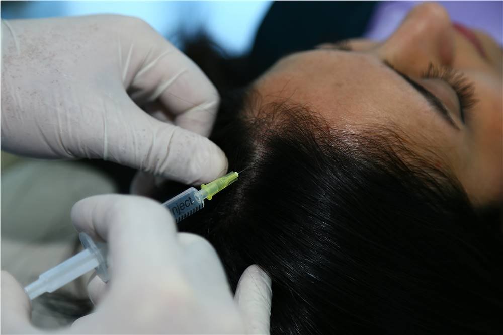 Saç Mezoterapisi | WWW İstanbul